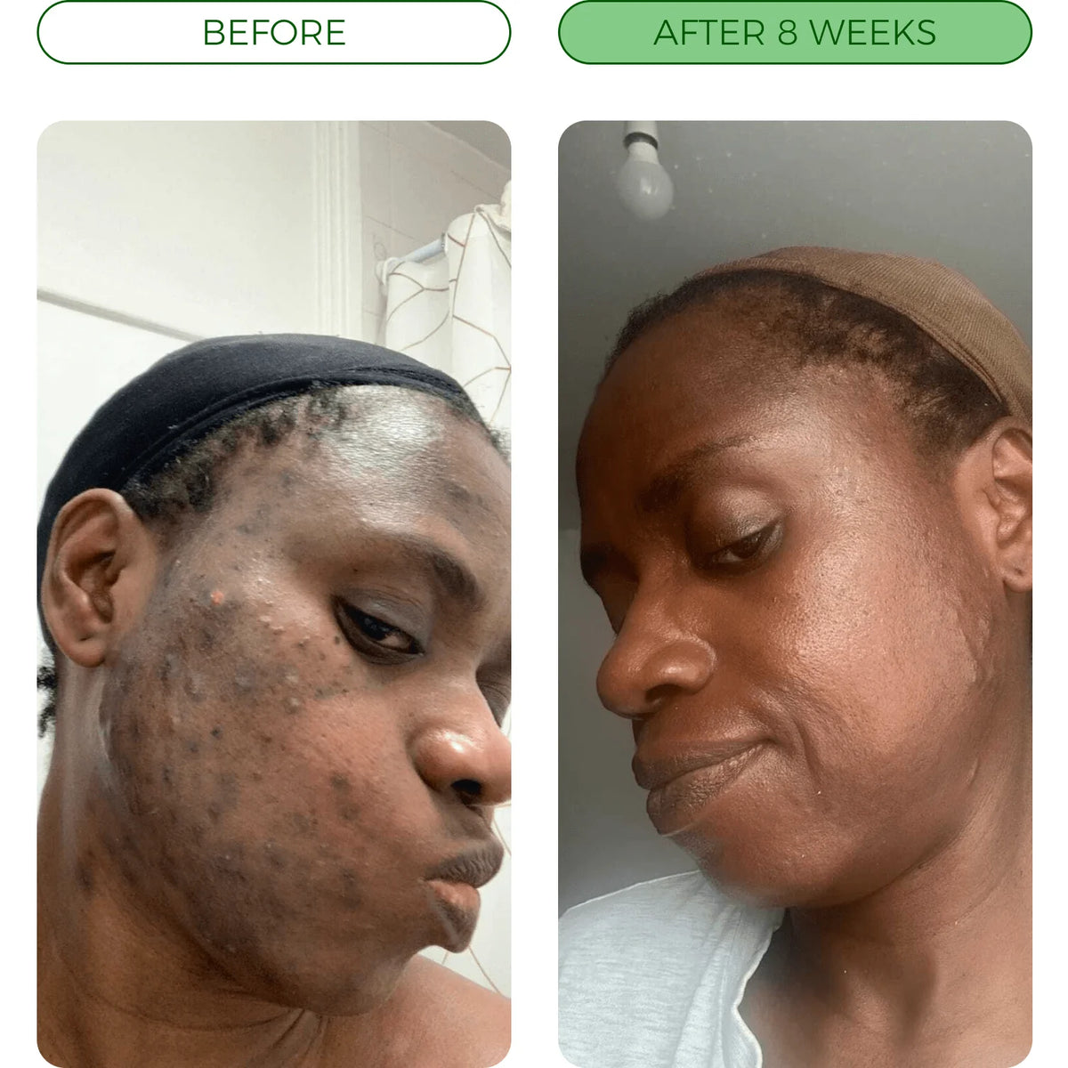 Before using DermaSoaps - skin results